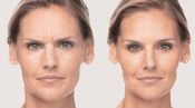What is Dysport Filler?