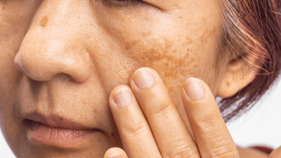 Close-up of an individual with melasma.