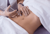 Hyacorp filler injection in abdomen.