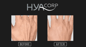 Transformative Effects of HYAcorp Fillers