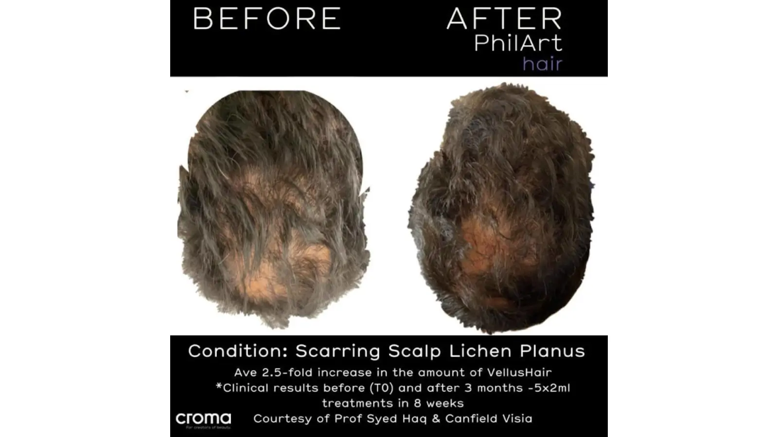 Side-by-side photos of a person's scalp before and after treatment for scarring scalp lichen planus, showing reduced baldness and increased hair density in the "after" image. Text details treatment and clinical results.