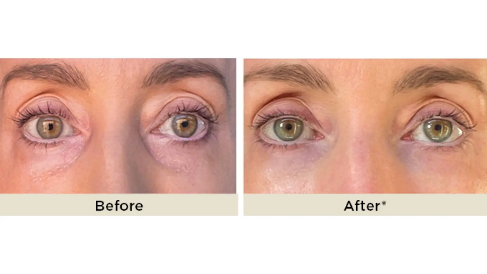 Side-by-side close-up of a woman’s eyes showing "Before" and "After" effects. The "After" image shows reduced under-eye puffiness and smoother skin compared to the "Before" image.
