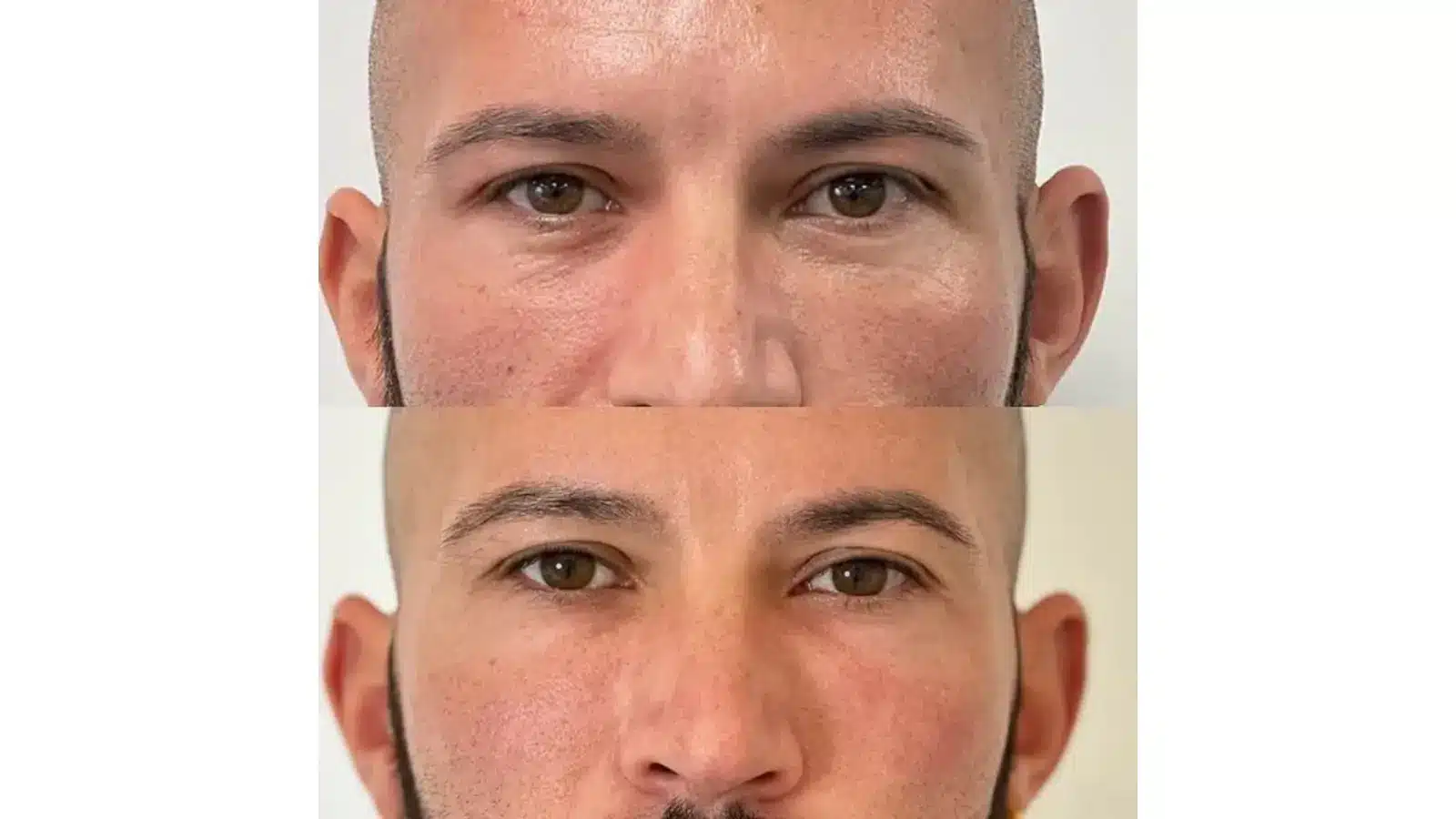 Two close-up photos of a bald man’s face, shown from the forehead to the upper lip. The top image shows darker skin and more uneven texture under the eyes; the bottom image shows smoother, more even-toned skin.