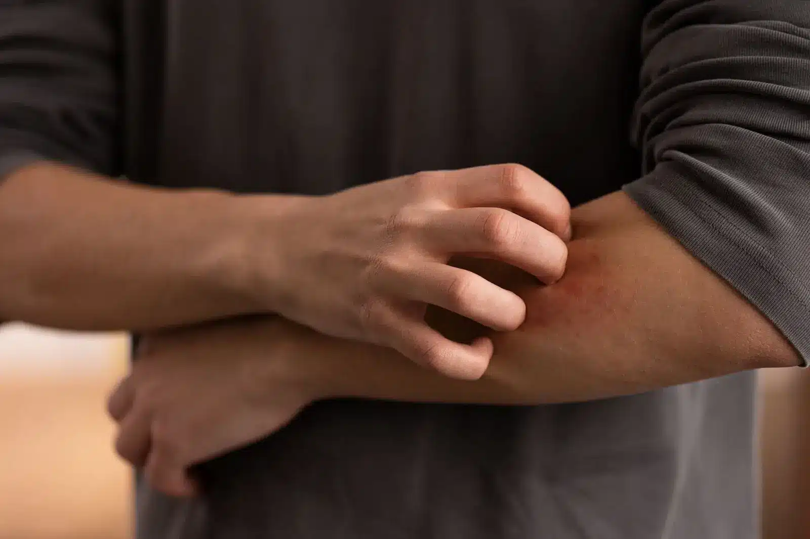 A person wearing a long-sleeve shirt scratches a red, irritated patch of skin on their forearm with their other hand.