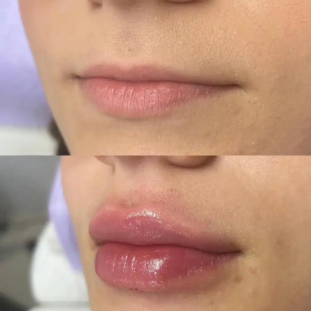 Before and after lip filler.