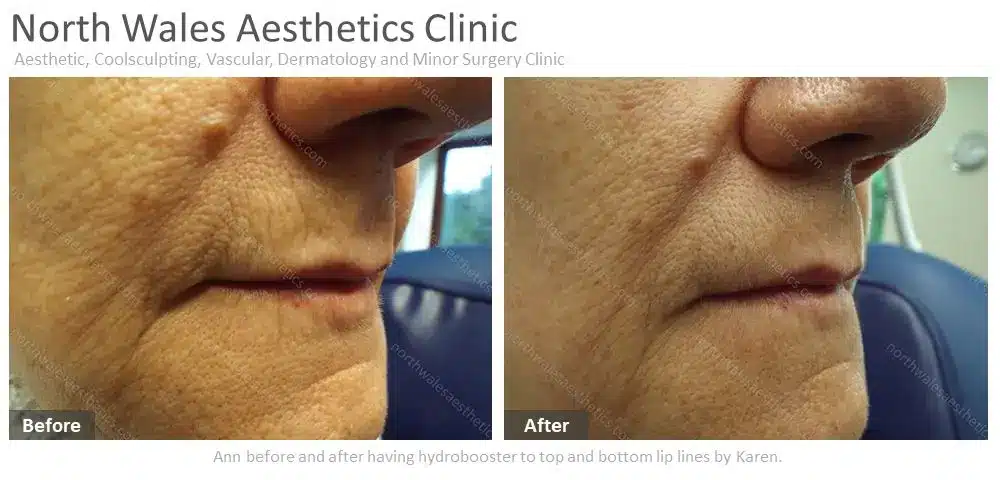 Before and after images showing the effects of a hydrobooster treatment on the top and bottom lip lines of a person's face. The left image shows more pronounced lines, and the right image shows smoother skin.