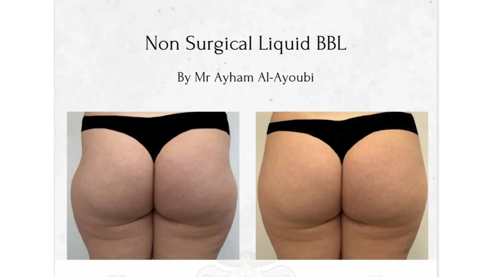 Two side-by-side images show the back view of a person in black underwear, before and after a non-surgical liquid BBL procedure. The text above reads: "Non Surgical Liquid BBL" by Mr Ayham Al-Ayoubi.