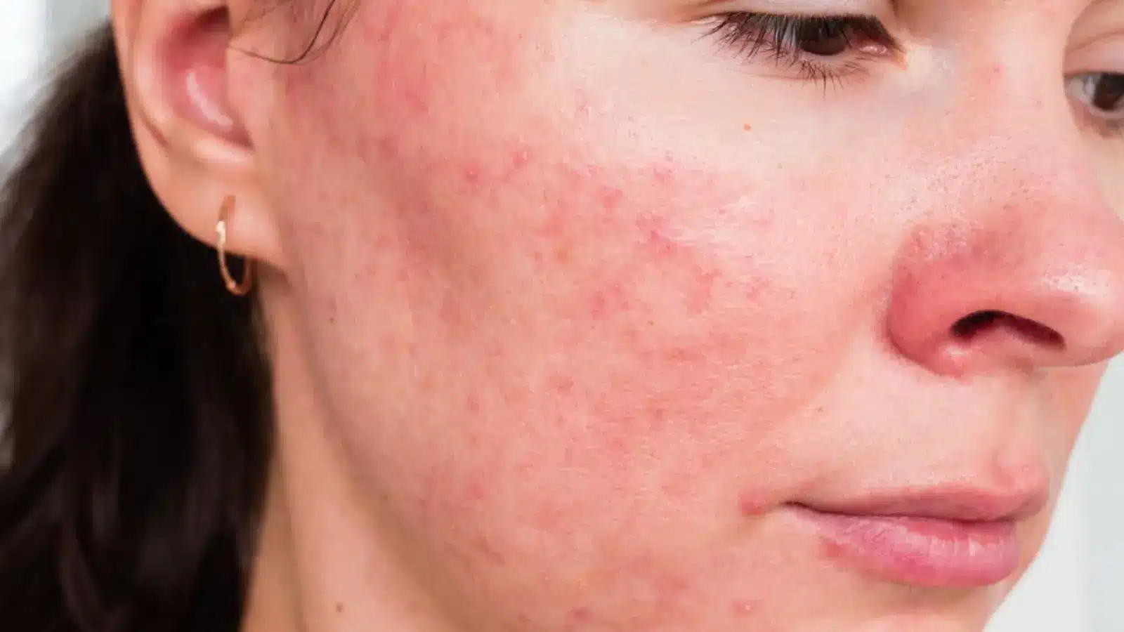 Close-up of a woman's face showing red, irritated skin with acne and blemishes on her cheek and nose. She has light skin, brown hair, and is wearing a small gold hoop earring.