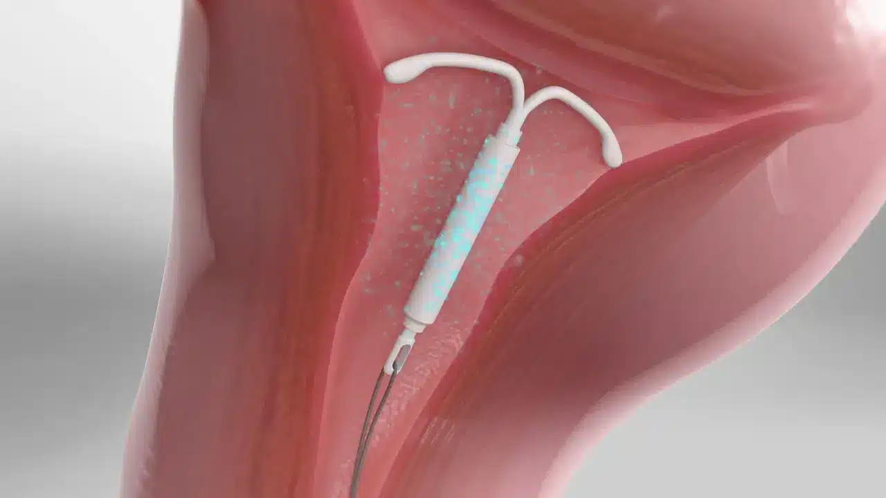 Medical illustration of an intrauterine device (IUD) inserted inside a uterus, showing the T-shaped device releasing medication or hormones for contraception.