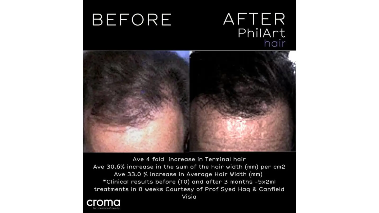 Side-by-side photos of a person’s scalp before and after hair treatment. The "After" image shows visibly thicker and fuller hair compared to the "Before" image. Text details increase in hair and clinical results.