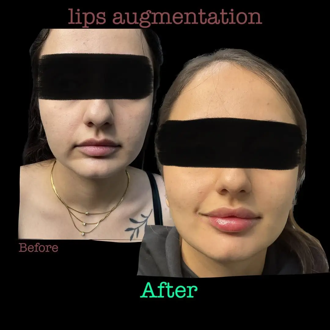 Before and after lip fillers.