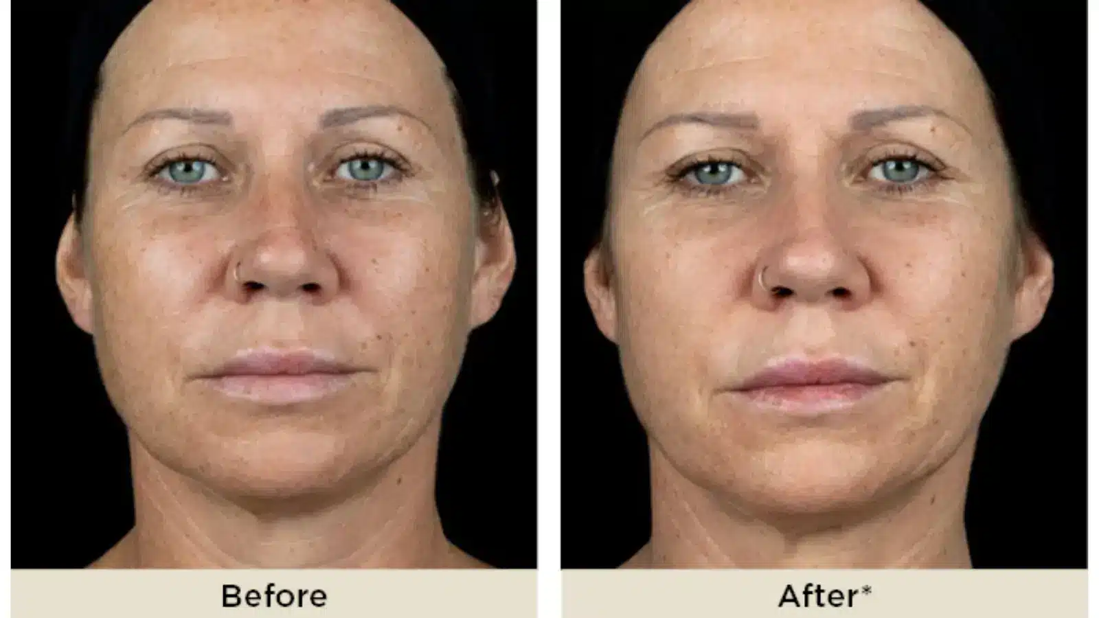 Side-by-side comparison of a woman's face before and after a treatment, showing smoother skin and reduced wrinkles in the "After" image. Both images have similar lighting and expression.