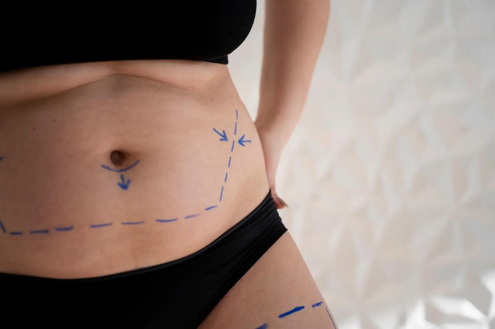 A close-up of a person’s midsection with blue surgical markings on the skin, indicating areas for a possible cosmetic procedure. The person is wearing black underwear and a black top.