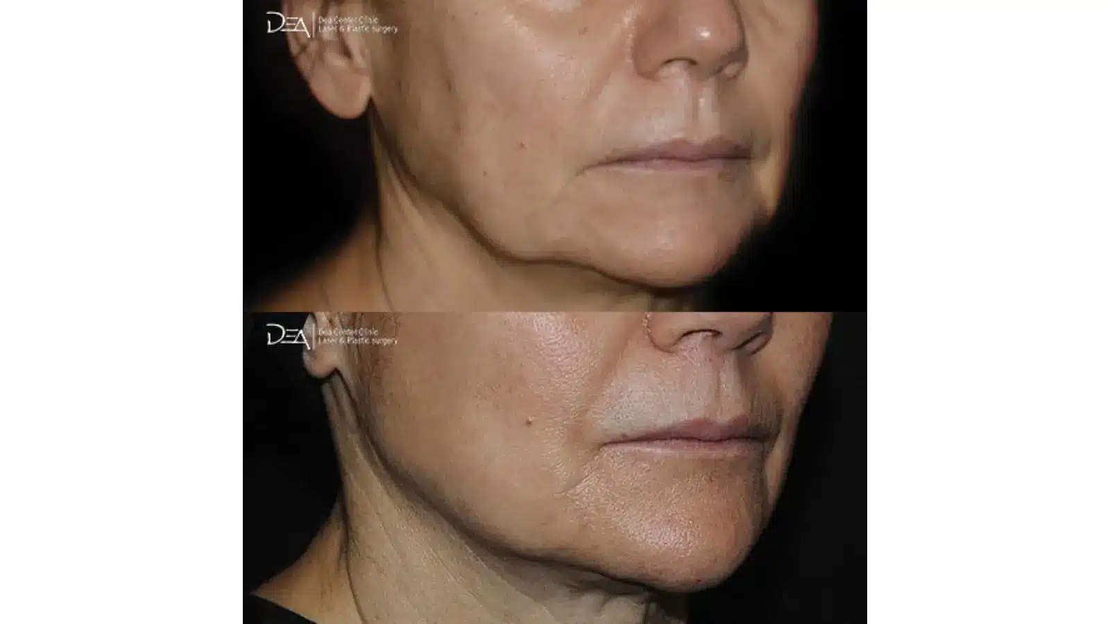 Close-up before-and-after photos of a person's lower face and jawline, showing smoother and tighter skin with reduced sagging in the after image, suggesting a cosmetic procedure or treatment.