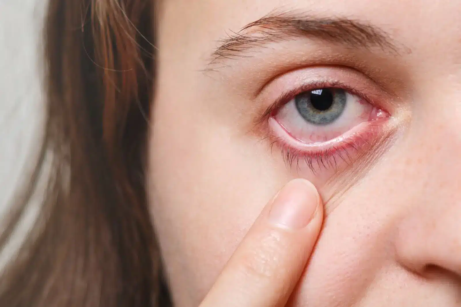 Close-up of a person with light skin and blue eyes touching the skin below their red, irritated eye, suggesting possible eye infection or irritation.