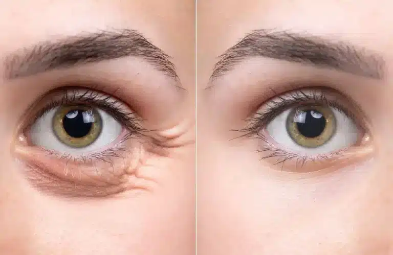 MSS_-Restylane-Eyelight