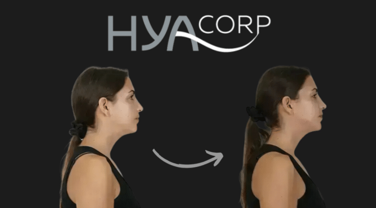 HYAcorp Before and After: How Dermal Fillers Can Enhance Your Appearance