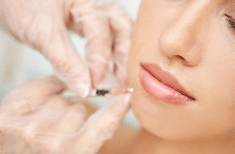 Professional cosmetic procedure with Juvederm injectable gel for natural-looking lip enhancement.