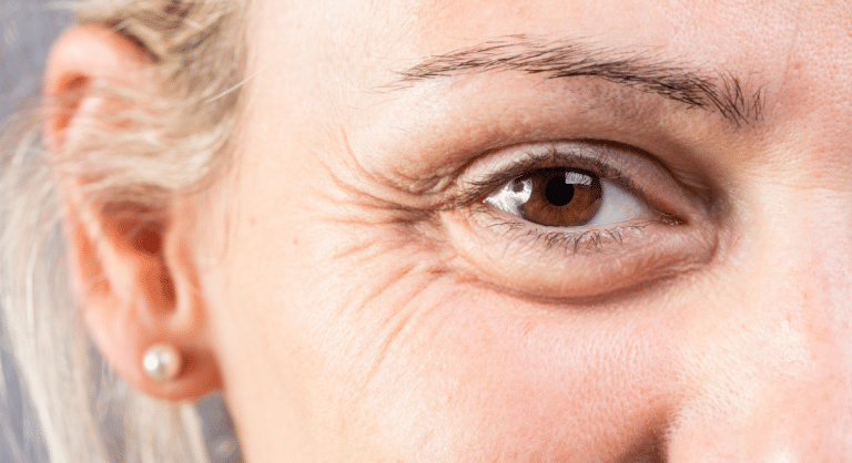 Unlocking the Power of Dysport: Why It's the Best Choice for Dynamic Wrinkles