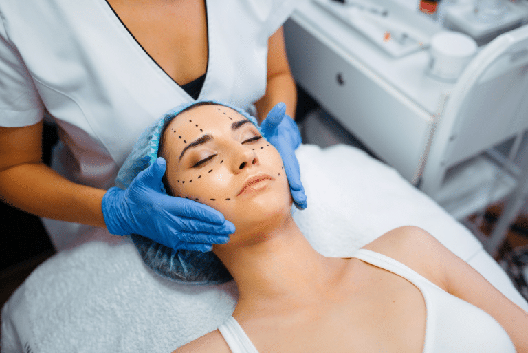 Pre-Juvederm facial treatment markings.