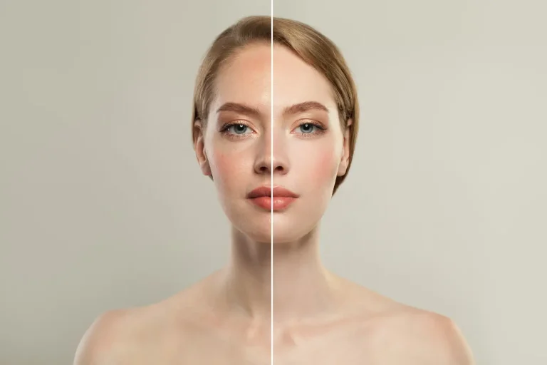 Ellanse before and after