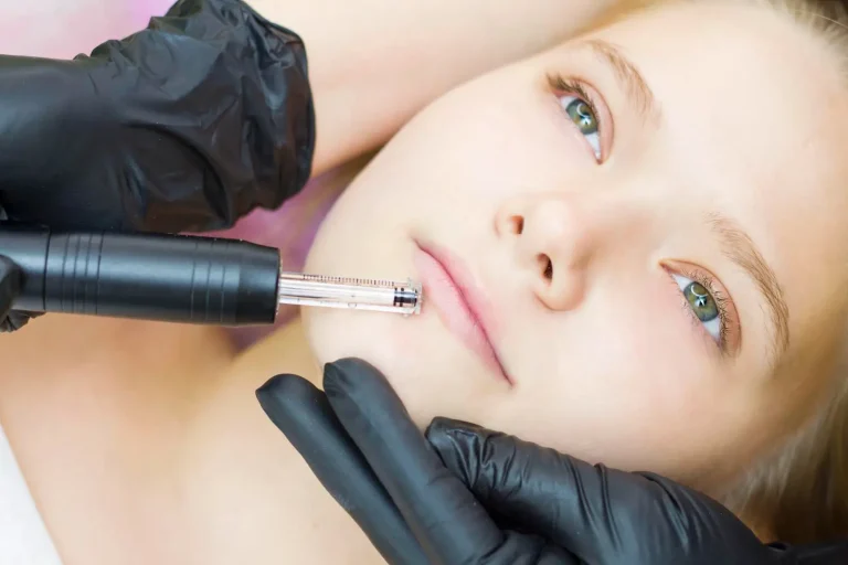 Teosyal dermal filler