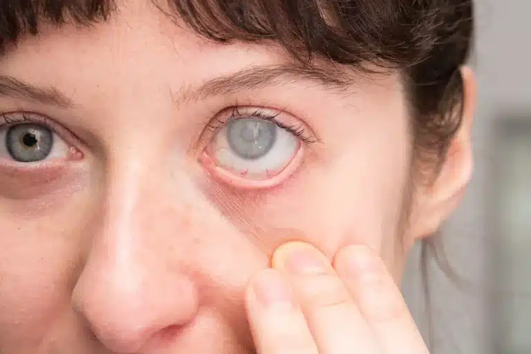 Lumigan eye drops for Glaucoma