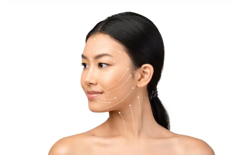 A woman with long dark hair tied back is shown against a white background. Dotted white lines and arrows are drawn on her face and neck, depicting suggested directions for cosmetic procedures. She is looking to her right.