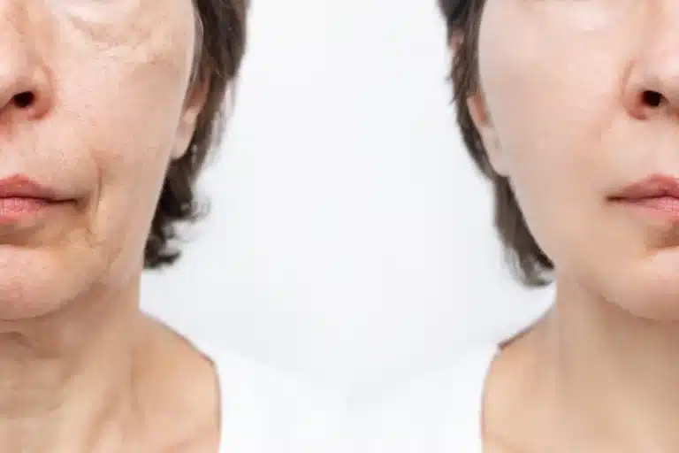 Jalupro before and after