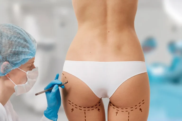 Sculptra for buttocks