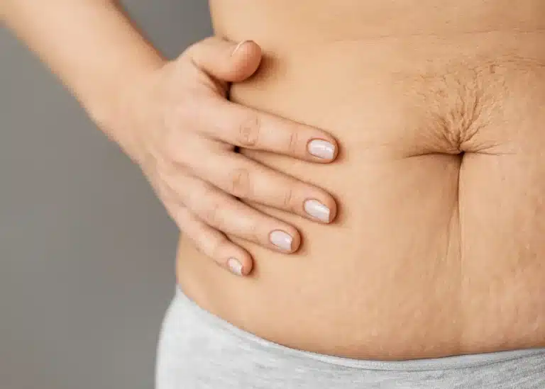 Sculptra for cellulite