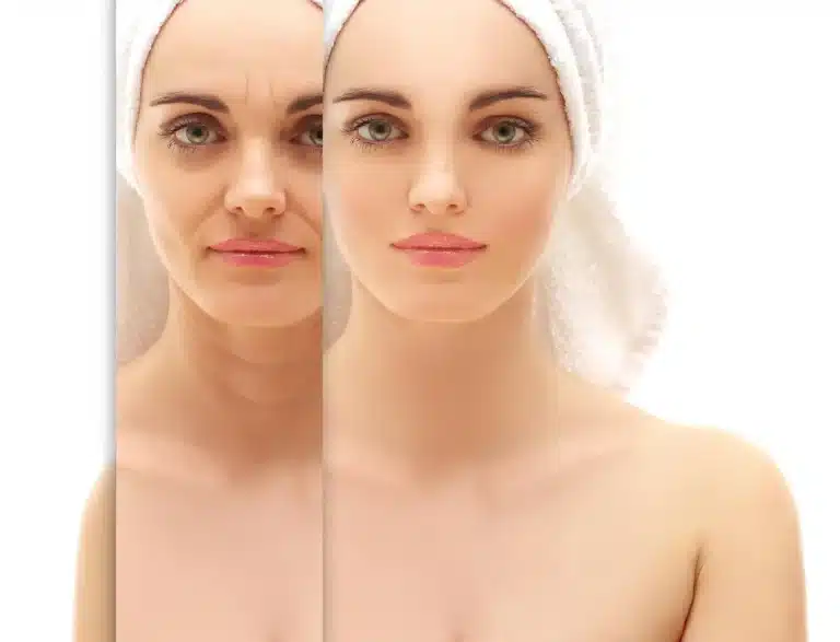 Sculptra face lift
