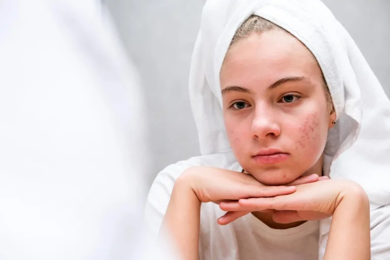 Stylage filler side effects