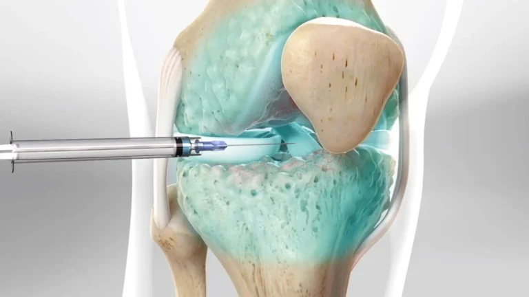 Illustration of a medical injection into a knee joint, showing a syringe inserting liquid into the cartilage area of the joint, highlighting parts of the knee structure in blue and beige.