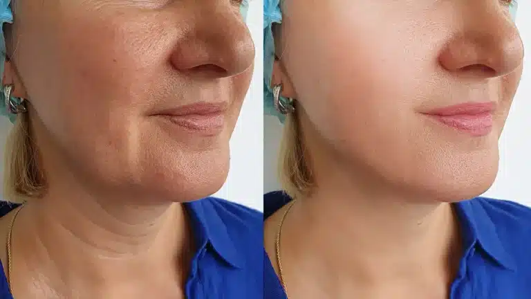 A side-by-side comparison of a woman's lower face before and after treatment. The left image shows more visible wrinkles and uneven skin texture, while the right image shows smoother and more even skin. She is wearing a blue shirt and earrings.