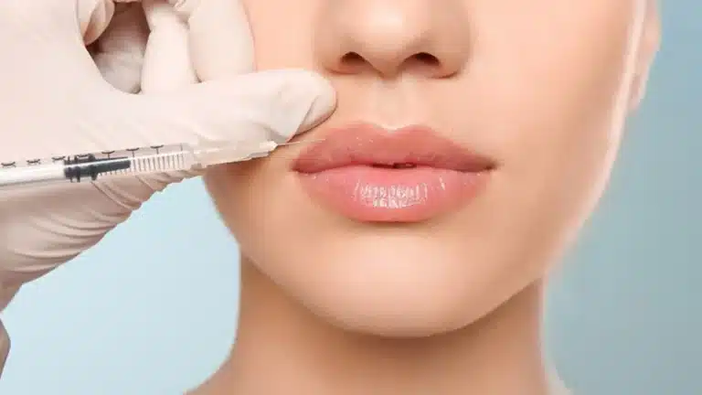 Lip filler.
