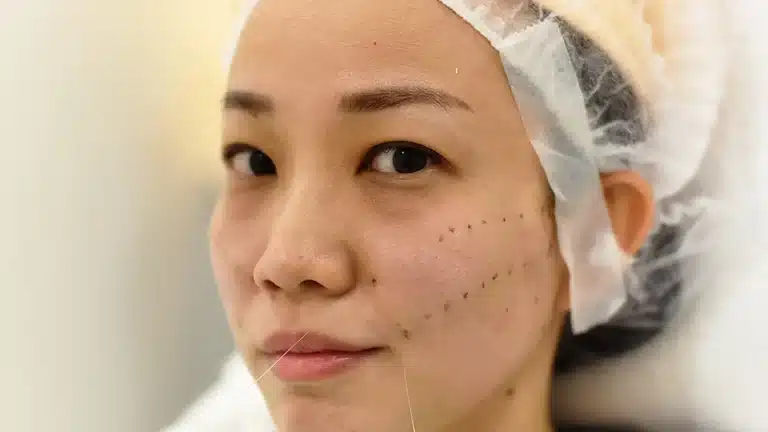 A person with dark hair is wearing a hair cap and undergoing a cosmetic procedure involving threads on their face. Marks are visible on one cheek, indicating treatment areas. The background is blurred, focusing on the person.