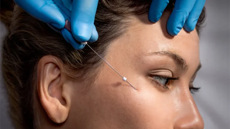 A close-up of a person receiving a cosmetic procedure with a needle. A gloved hand is holding the needle near the side of their face, focusing on an area close to the temple. The person's eyes are closed.
