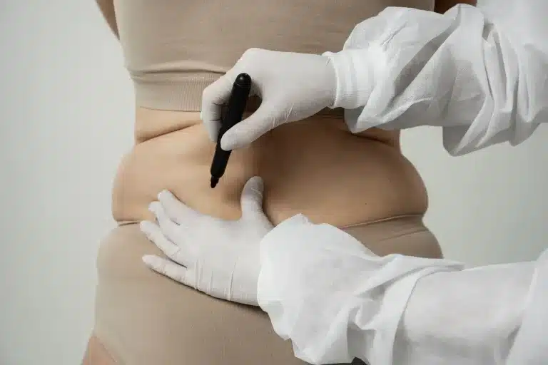 A person in beige clothing has marks drawn on their abdomen by someone wearing white gloves and a medical gown, suggesting preparation for a cosmetic or medical procedure.