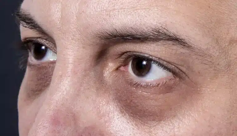 A close-up of a person's eyes and upper nose, showing dark circles under both eyes. The skin appears textured and natural, and the person has brown eyes and dark eyebrows.