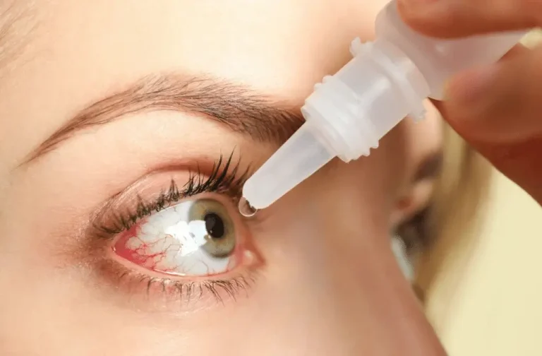 A close-up of a person’s eye with visible redness as they apply eye drops from a small bottle, holding the bottle above the eye and squeezing a drop onto the eye’s surface.